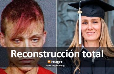 Reconstrucción total